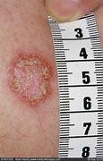 Image result for Red Painful Skin Eruptions