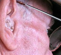 Image result for Hearing Aids Medication OTC