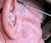 Image result for Over the Counter Hearing Aids