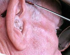Image result for Over the Counter Hearing Aids Boots