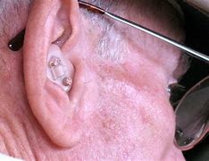 Image result for Over the Counter Hearing Aids Walmart
