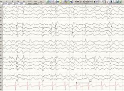 Image result for Bilateral Sharp Spikes EEG