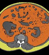Image result for Splenic Angiosarcoma CT