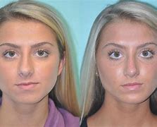 Image result for facial augmentation implants