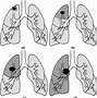 Image result for Wedge Resection Lung Surgery