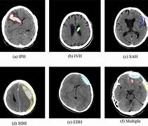 Image result for Iph CT