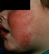 Image result for Fifths Disease Rash Itchy