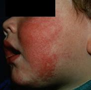 Image result for Fifths Disease Age Group