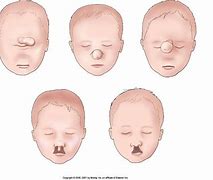 Image result for Cyclopia in Humans