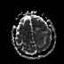 Image result for Atypical Meningioma