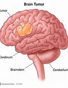 Image result for Head Tumor