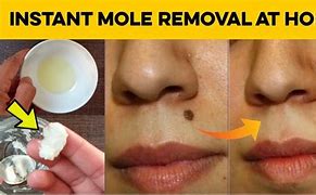Image result for Natural Mole Removal