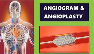 Image result for Angiogram Wound