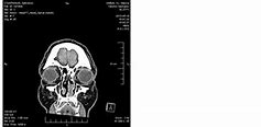 Image result for How Big Is a 2 5 Cm Tumor