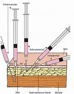 Image result for 90 Degree House Needle Images Surgery