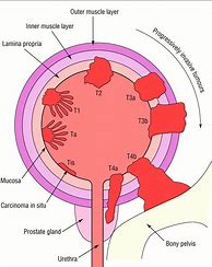 Image result for 2 Centimeter Tumor