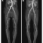 Image result for Left Leg Angiogram