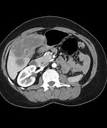 Image result for Gallbladder Mass CT