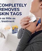 Image result for Freezing Skin Tags
