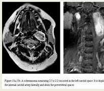 Image result for Schwannoma Tumor Neck