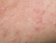 Image result for Dermatitis Torso
