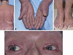 Image result for Mycosis Fungoides Eye