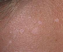 Image result for Scalp Papilloma