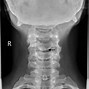 Image result for C5 Vertebrae