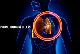 Image result for Left Apical Pneumothorax