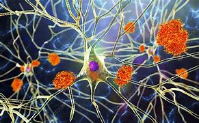 Image result for Alzheimer Neuron