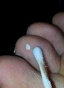 Image result for Palmar Wart Removal