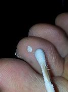 Image result for Plantar Wart On Ball of Foot