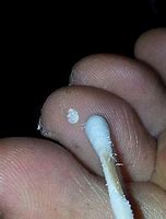 Image result for Wart Removal Creams