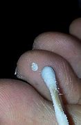 Image result for Wart Removal Products