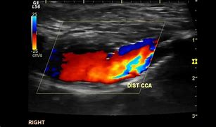 Image result for Vascular Doppler Ultrasound
