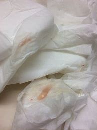 Image result for Mucus Plug with Blood