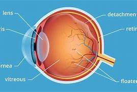 Image result for Eye Floater Vitreous Detachment