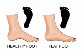 Image result for Flat Foot vs Arched Foot
