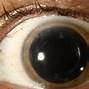 Image result for Posterior Chamber Intraocular Lens