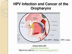 Image result for HPV-positive Oropharyngeal Cancer
