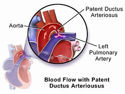 Image result for Pulmonary Artery PDA