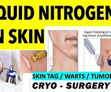 Image result for Cryotherapy Skin Tag Removal