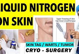 Image result for Freezing Skin Tags