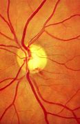 Image result for Glaucoma
