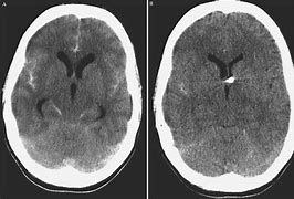Image result for Acute Hydrocephalus