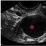 Image result for Cyst On Ovarian Cancer Ultrasound