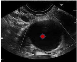 Image result for 2 Cm Cyst On Ovary