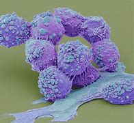 Image result for Brain Tumor Cells