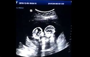 Image result for Identical Twins Ultrasound