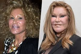 Image result for Bad Face Lifts Before and After
